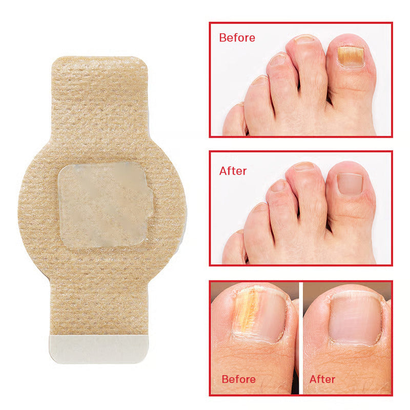 Onychomycosis stickers
